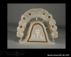 All on six. Zirconia restoration