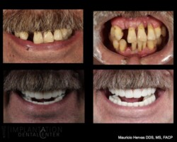 Before and after. Upper and lower full zirconia restorations